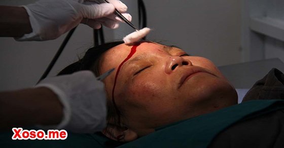 Mơ thấy người ta đánh mẹ chảy máu đầu